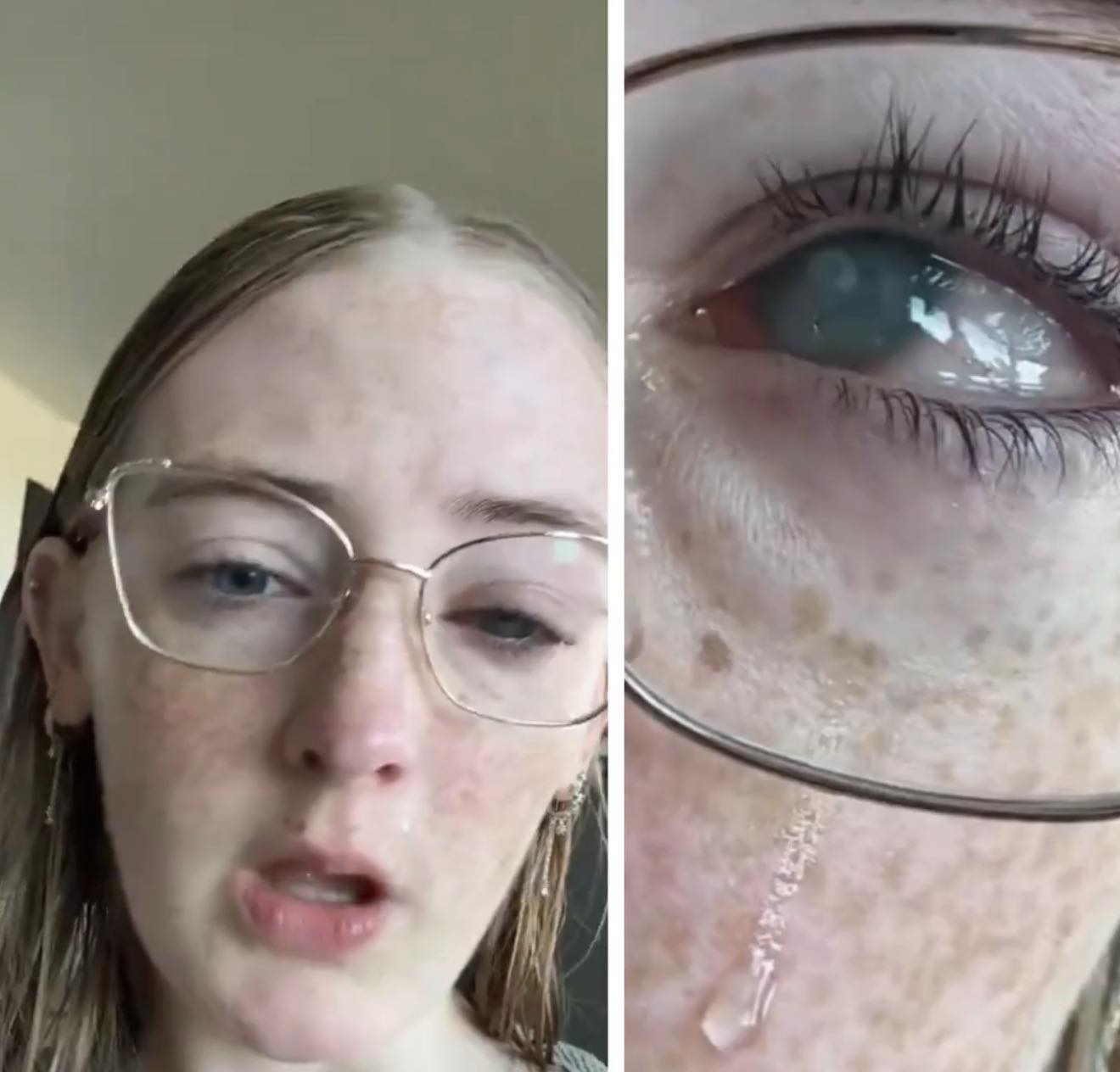 قصة تتحول لتحذير طبي: الاستحمام بالعدسات اللاصقة قد يكلّفك بصرك